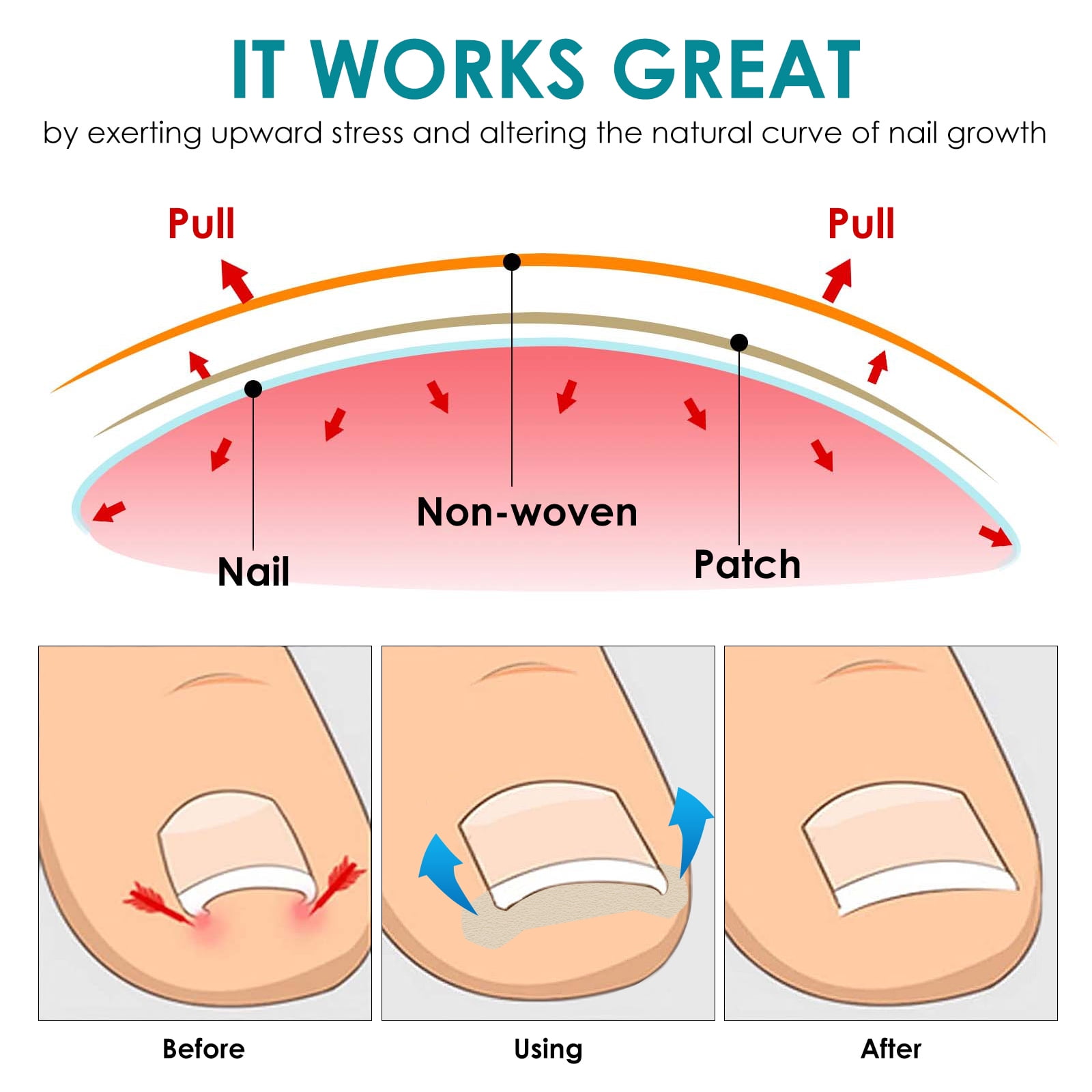 Ingrown Toenail Treatment Tool, No Glue 60Pcs Ingrown Toenail Corrector Patch, Professional Ingrown Toenail Removal Kit with 2 Pedicure Tools for Ingrown Toenail Remover
